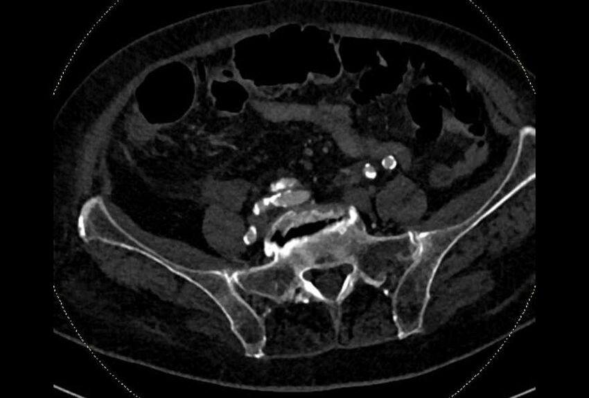 Abdominal aortic aneurysm with thrombus fissuration (Radiopaedia 73192-83919 Axial C+ arterial phase 158).jpg