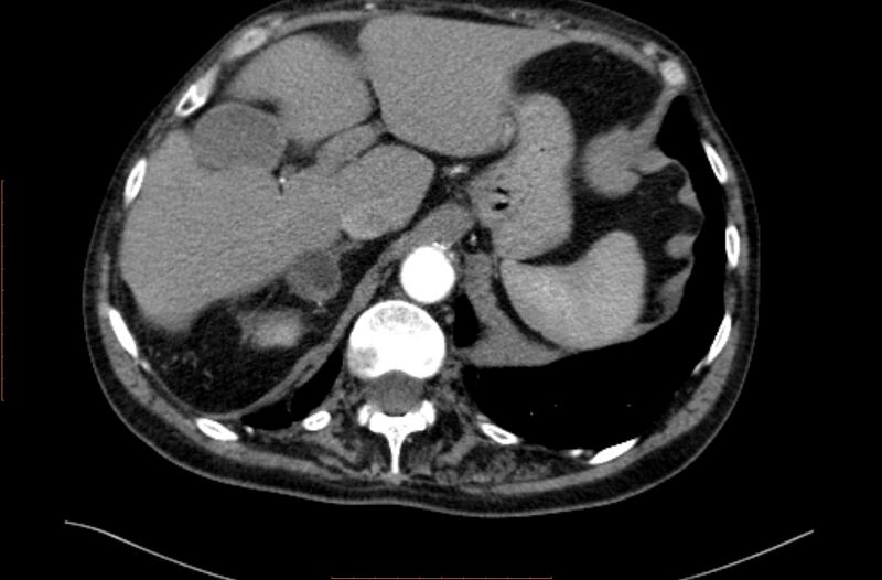 File:Abdominal aortic interposition tube graft and aneurysm thrombosis (Radiopaedia 71438-81857 Axial C+ arterial phase 4).jpg