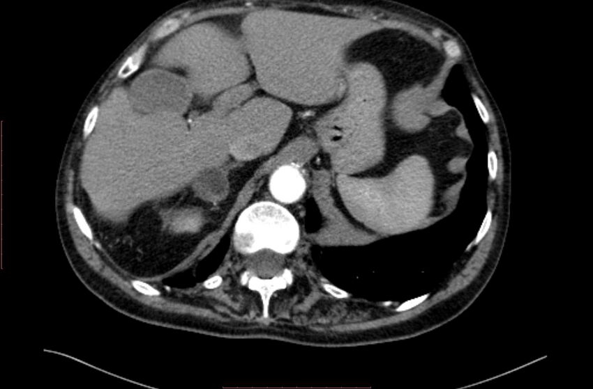 Abdominal aortic interposition tube graft and aneurysm thrombosis (Radiopaedia 71438-81857 Axial C+ arterial phase 4).jpg
