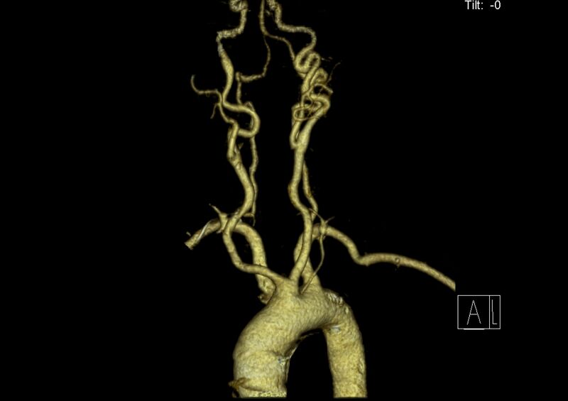 File:Aberrant right subclavian artery (Radiopaedia 19283-19294 3D reconstruction C+ arterial phase 8).jpg