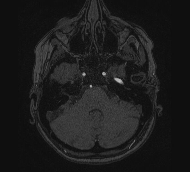 File:Accessory middle cerebral artery and ICA aneurysm (Radiopaedia 22656-22674 MRA 3).jpg