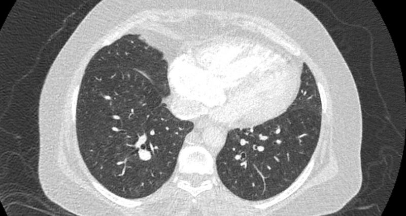 File:Accessory right inferior hepatic vein (Radiopaedia 65245-74259 Axial lung window 53).jpg