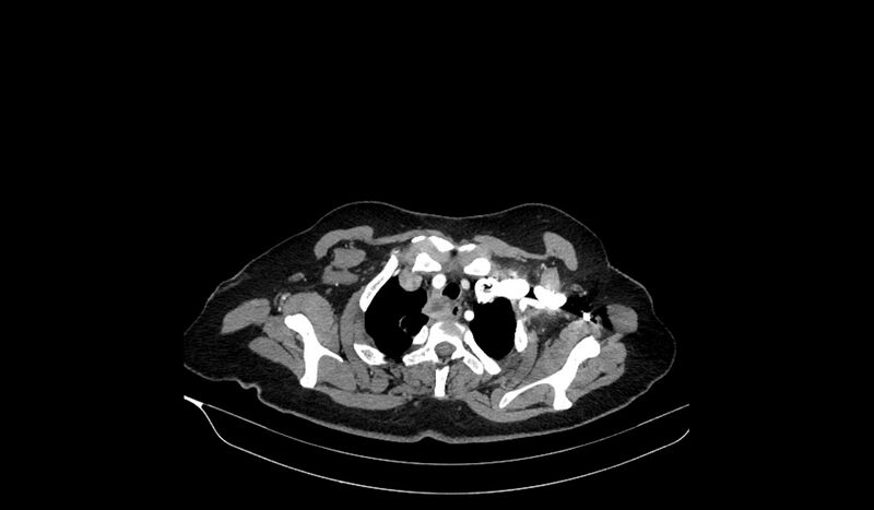 File:Acquired tracheo-esophageal fistula (Radiopaedia 51356-57103 Axial C+ arterial phase 18).jpg