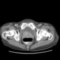 Actinomycosis related to longstanding IUD (Radiopaedia 77303-89380 Axial C+ portal venous phase 81).jpg