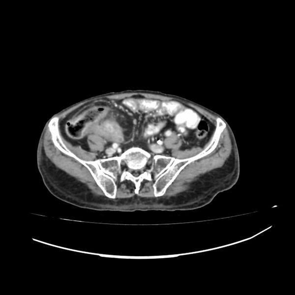 File:Acute-on-chronic Crohn disease with enteroenteric fistula (Radiopaedia 66686-75987 B 42).jpg