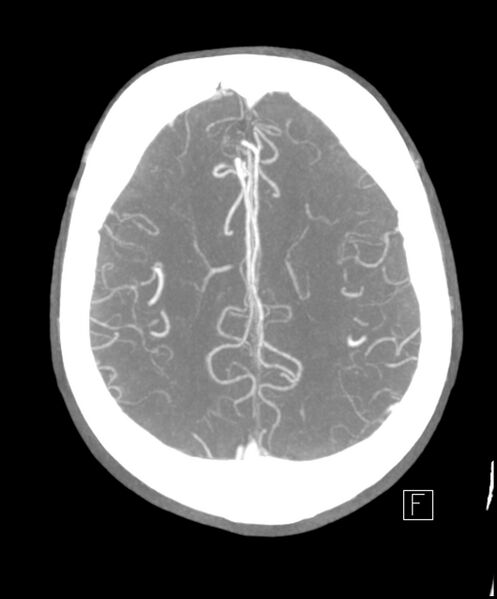 File:Acute P1 occlusion with PCA ischemia penumbra (CT perfusion) (Radiopaedia 72084-82587 Axial C+ arterial thick MIP 4).jpg