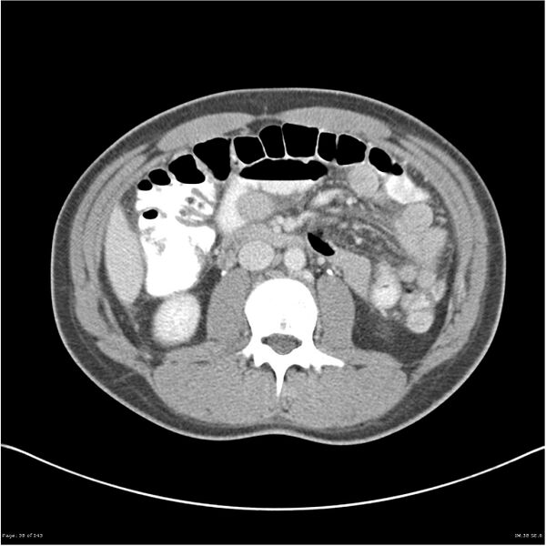 File:Acute appendicitis (Radiopaedia 25364-25615 B 28).jpg