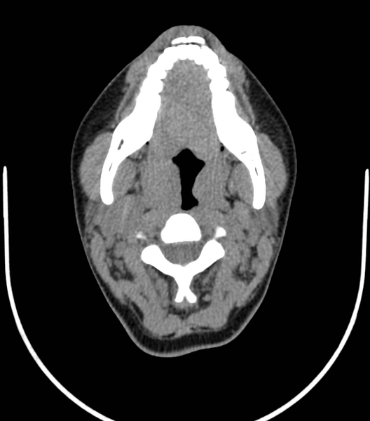 File:Acute bacterial tonsillitis (Radiopaedia 22882-22908 Axial non-contrast 20).png