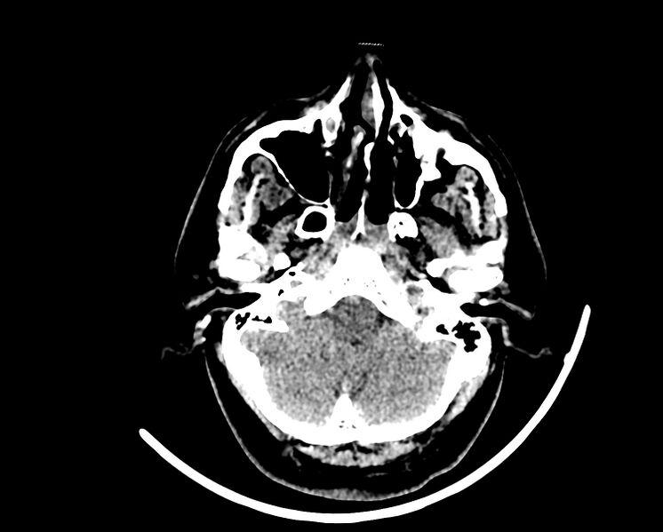 File:Acute cerebral infarct (Radiopaedia 35604-37123 Axial non-contrast 14).jpg