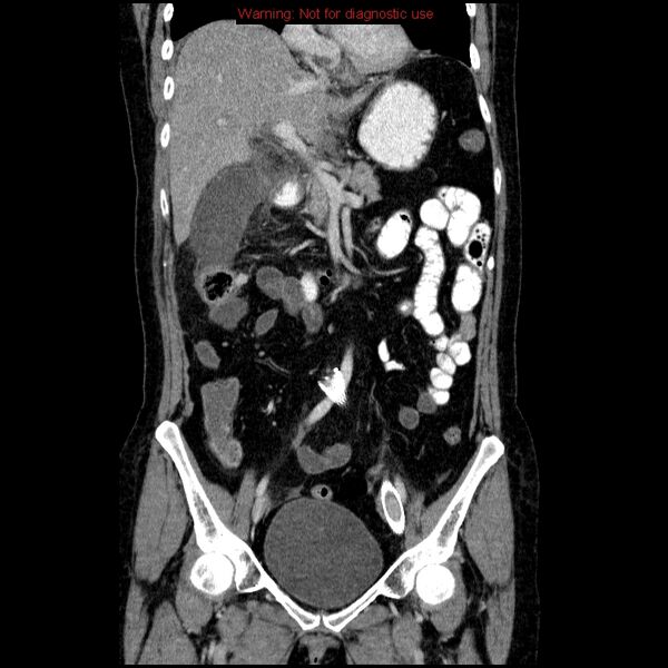 File:Acute gangrenous cholecystitis (Radiopaedia 10123-10661 Coronal C+ portal venous phase 11).jpg