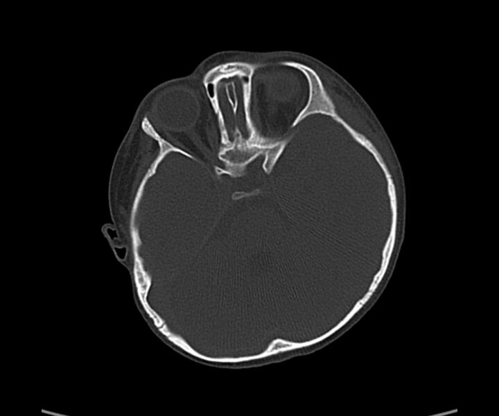 File:Acute hemorrhagic contusion (Radiopaedia 63660-72336 Axial bone window 23).jpg