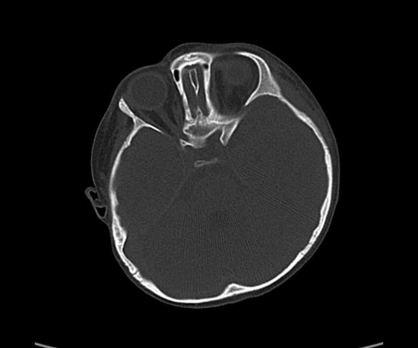 Acute hemorrhagic contusion (Radiopaedia 63660-72336 Axial bone window 23).jpg
