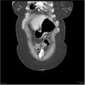 Acute pancreatitis (Radiopaedia 19136-19117 Coronal C+ portal venous phase 2).jpg