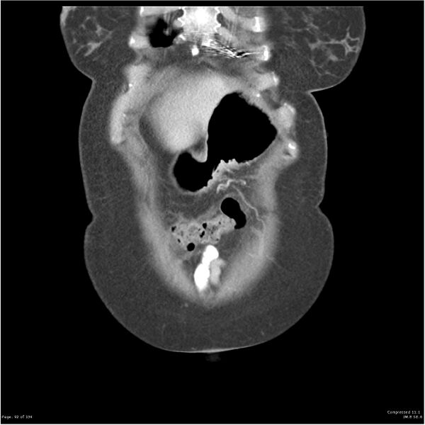 File:Acute pancreatitis (Radiopaedia 19136-19117 Coronal C+ portal venous phase 2).jpg