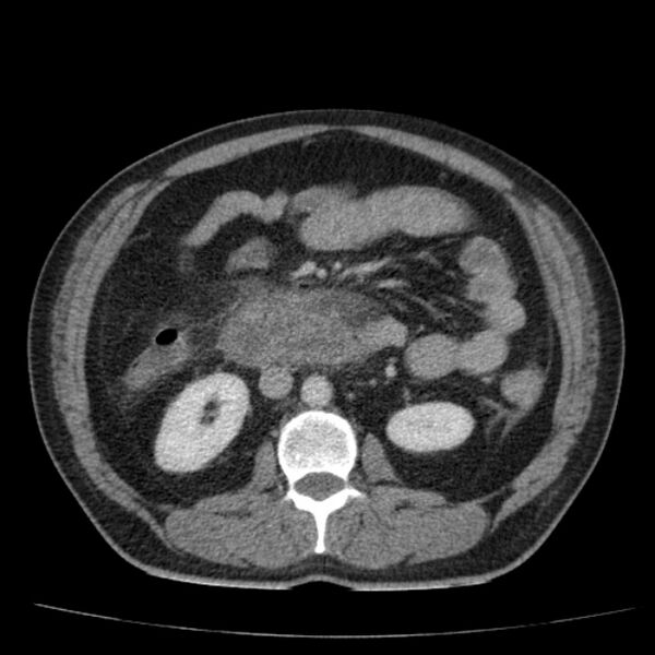 File:Acute pancreatitis (Radiopaedia 26663-26813 Axial C+ portal venous phase 41).jpg