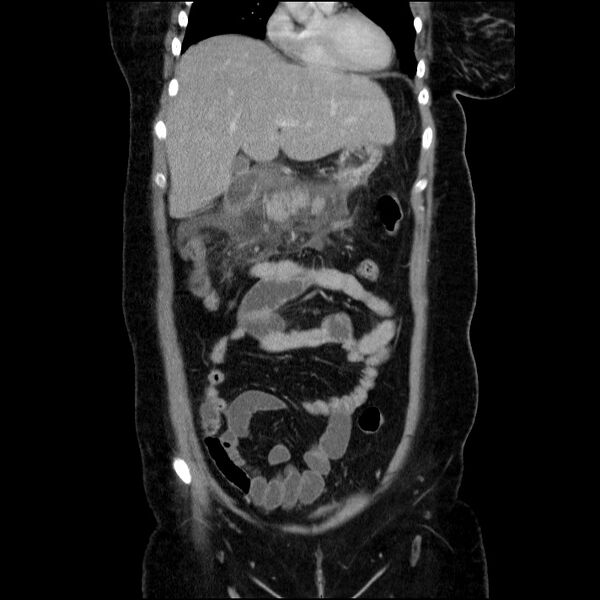 File:Acute pancreatitis (Radiopaedia 69236-79012 Coronal C+ portal venous phase 51).jpg