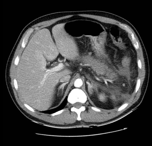 File:Acute pancreatitis - Balthazar E (Radiopaedia 23080-23110 Axial C+ arterial phase 18).jpg
