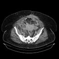 Acute pyelonephritis (Radiopaedia 25657-25837 Axial renal parenchymal phase 64).jpg