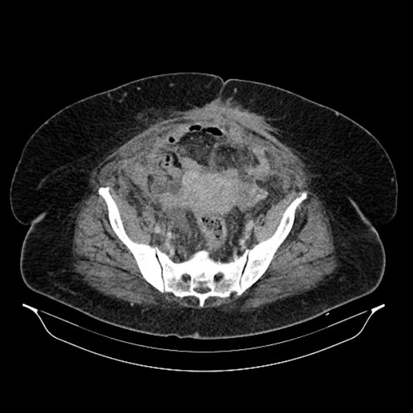 File:Acute pyelonephritis (Radiopaedia 25657-25837 Axial renal parenchymal phase 64).jpg