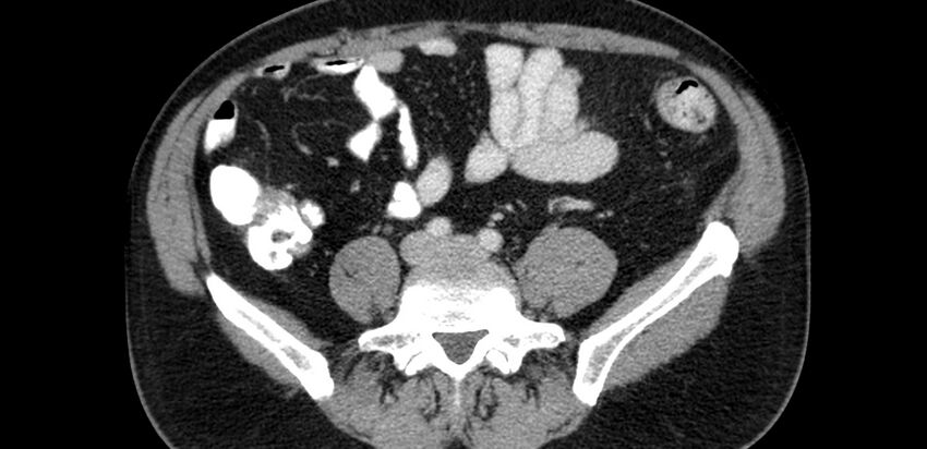 Acute sigmoid colon diverticulitis (Radiopaedia 55507-61976 Axial C+ portal venous phase 54).jpg