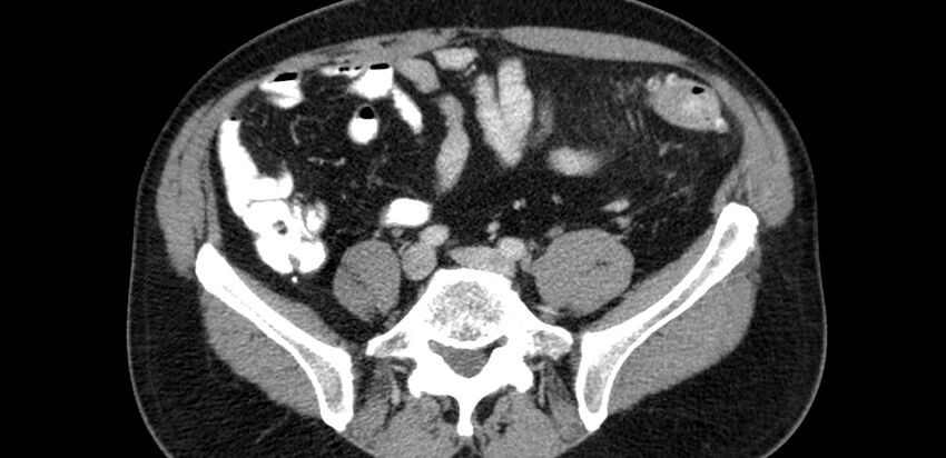 Acute sigmoid colon diverticulitis (Radiopaedia 55507-61976 Axial C+ portal venous phase 59).jpg