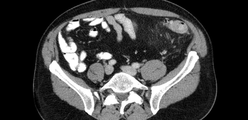 Acute sigmoid colon diverticulitis (Radiopaedia 55507-61976 Axial C+ portal venous phase 61).jpg