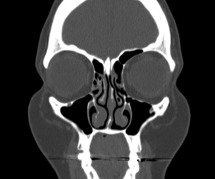 File:Acute sinusitis (Radiopaedia 22419-22455 Coronal bone window 11).jpg