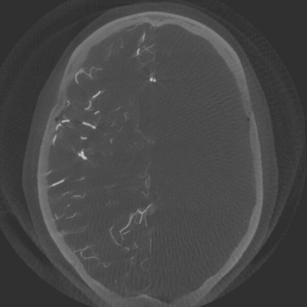 File:Acute subarachnoid hemorrhage and accessory anterior cerebral artery (Radiopaedia 69231-79010 Axial arterial - MIP 43).jpg