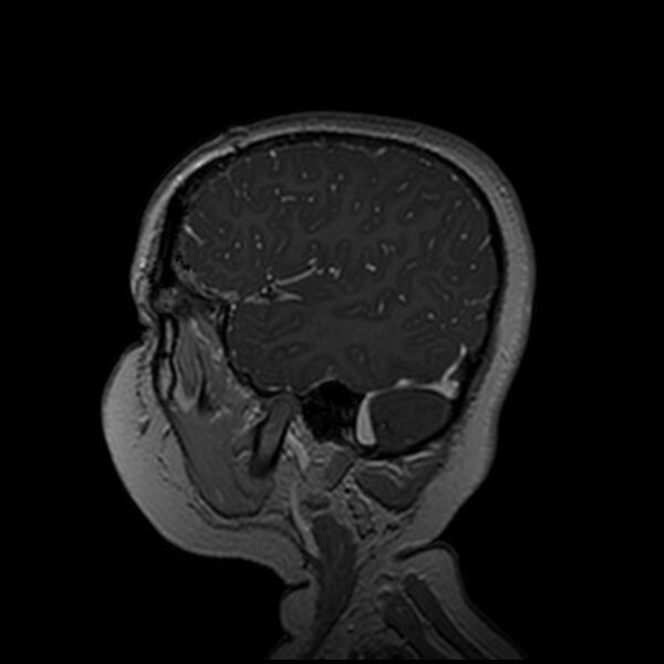File:Adamantinomatous craniopharyngioma (Radiopaedia 77407-89529 H 98).jpg