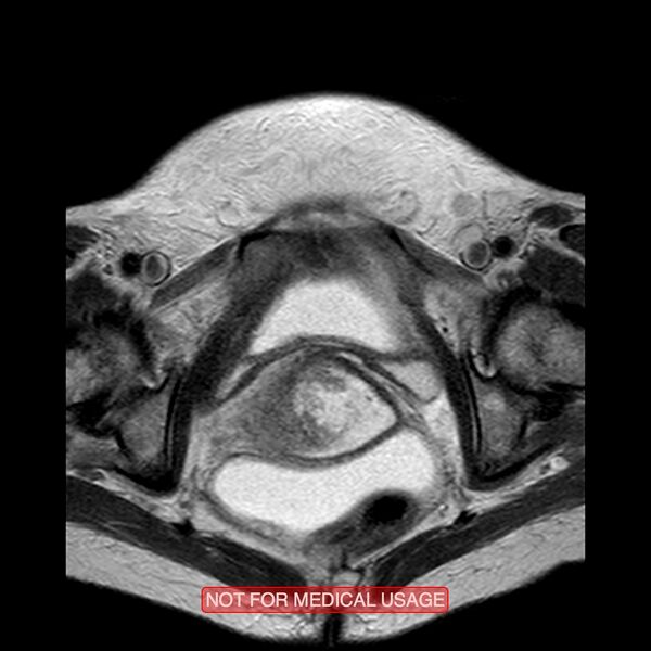 File:Adenocarcinoma of the cervix (Radiopaedia 28373-28615 Axial T2 5).jpg