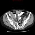 Adenocarcinoma of the colon (Radiopaedia 8191-9039 Axial liver window 60).jpg