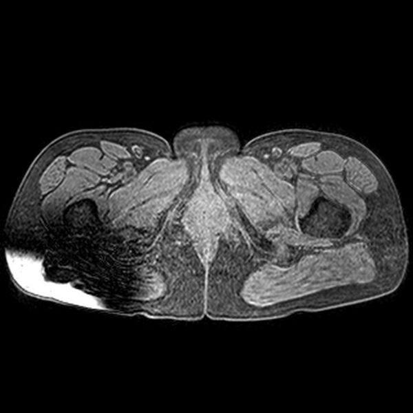 File:Adenomyoma of the uterus (huge) (Radiopaedia 9870-10438 Axial T1 fat sat 2).jpg