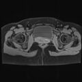 Adenomyosis and endometriotic cysts (Radiopaedia 82300-96367 Axial T1 C+ fat sat 4).jpg