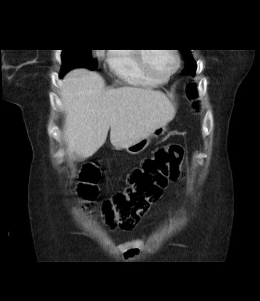 File:Adrenal cortical carcinoma with IVC invasion and thrombosis (Radiopaedia 34307-35597 Coronal C+ portal venous phase 14).jpg