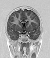 Aicardi syndrome (Radiopaedia 66029-75205 Coronal T1-IR 10).jpg