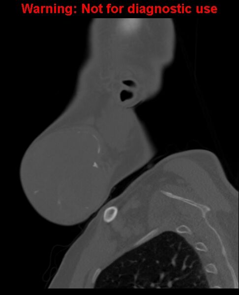 File:Ameloblastoma (Radiopaedia 33126-34164 Sagittal bone window 15).jpg
