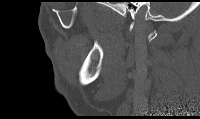 Ameloblastoma (Radiopaedia 33677-34806 Sagittal bone window 45).png