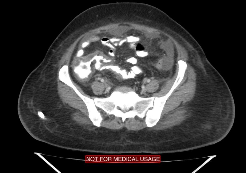 File:Amoebic enterocolitis with liver abscess (Radiopaedia 35100-36609 A 61).jpg
