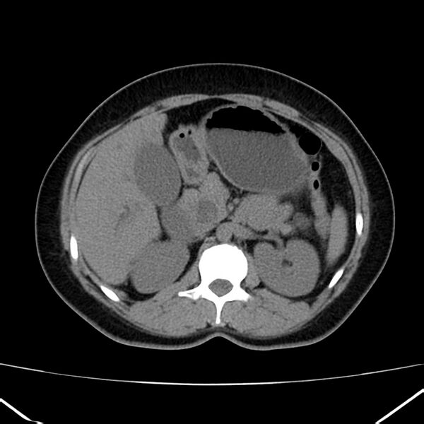 File:Ampullary tumor (Radiopaedia 22787-22816 Axial non-contrast 20).jpg