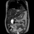 Ampullary tumor (Radiopaedia 27294-27479 Coronal T2 6).jpg