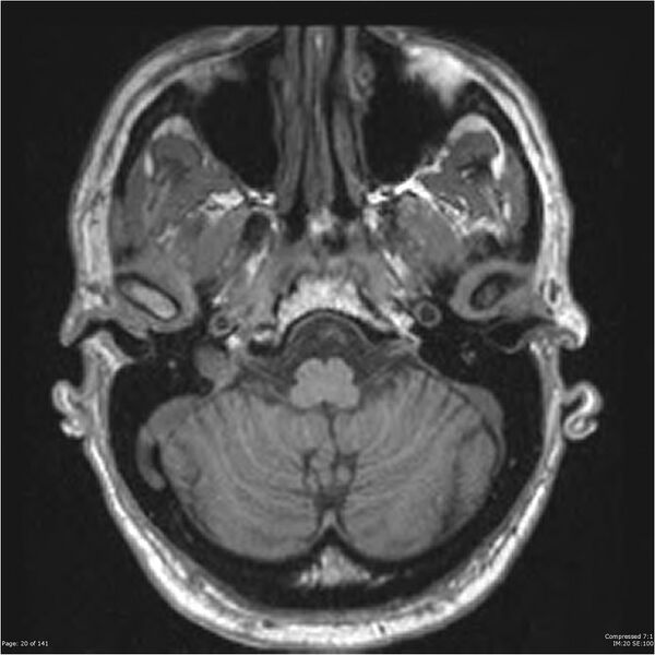 File:Anaplastic meningioma with recurrence (Radiopaedia 34452-35788 Axial T1 18).jpg