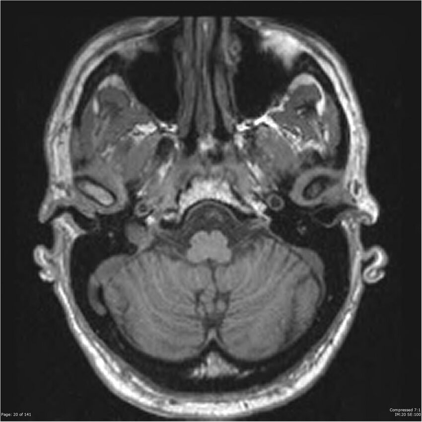 Anaplastic meningioma with recurrence (Radiopaedia 34452-35788 Axial T1 18).jpg