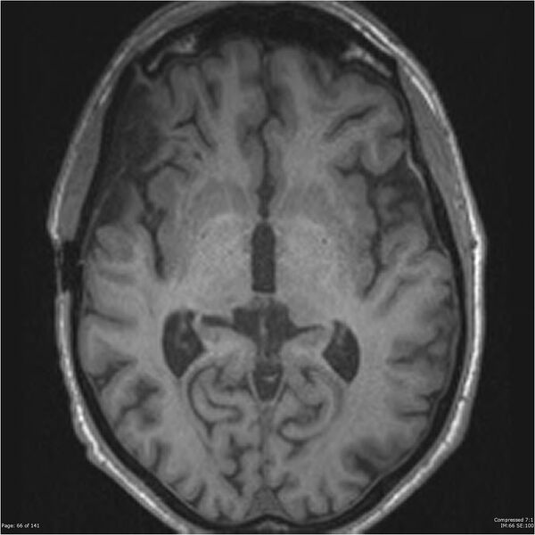 File:Anaplastic meningioma with recurrence (Radiopaedia 34452-35788 Axial T1 64).jpg