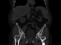 Ankylosing spondylitis (Radiopaedia 44609-48357 Coronal bone window 25).jpg