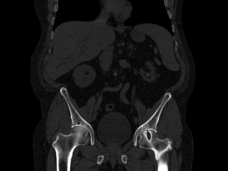 File:Ankylosing spondylitis (Radiopaedia 44609-48357 Coronal bone window 25).jpg