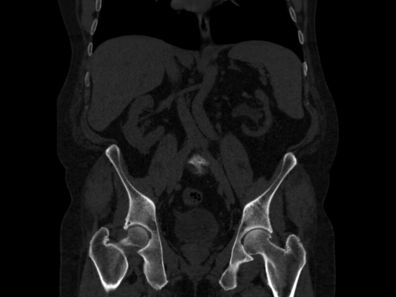 File:Ankylosing spondylitis (Radiopaedia 44609-48357 Coronal bone window 38).jpg
