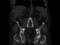Ankylosing spondylitis (Radiopaedia 44609-48357 Coronal bone window 46).jpg