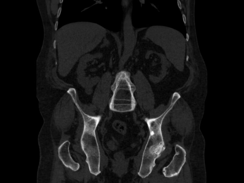 File:Ankylosing spondylitis (Radiopaedia 44609-48357 Coronal bone window 46).jpg