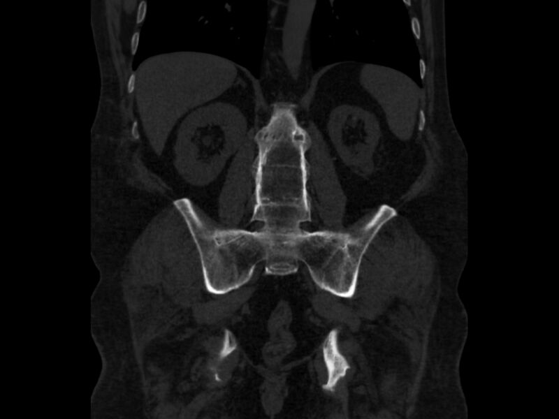 File:Ankylosing spondylitis (Radiopaedia 44609-48357 Coronal bone window 59).jpg