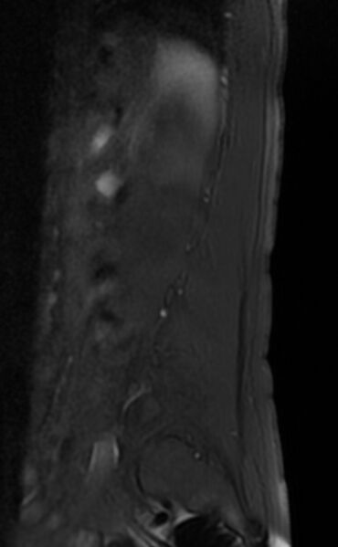 File:Ankylosing spondylitis - Andersson lesion (Radiopaedia 81878-95838 Sagittal T1 fat sat 12).jpg